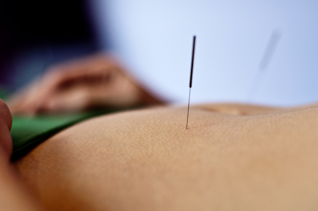 Acupunctura pe scurt